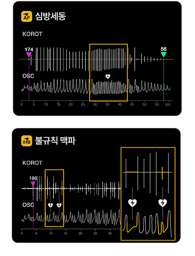 심방세동/불규칙 맥파 감지
